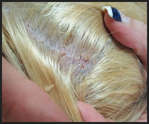 Burnt Scalp Burnt Scalp